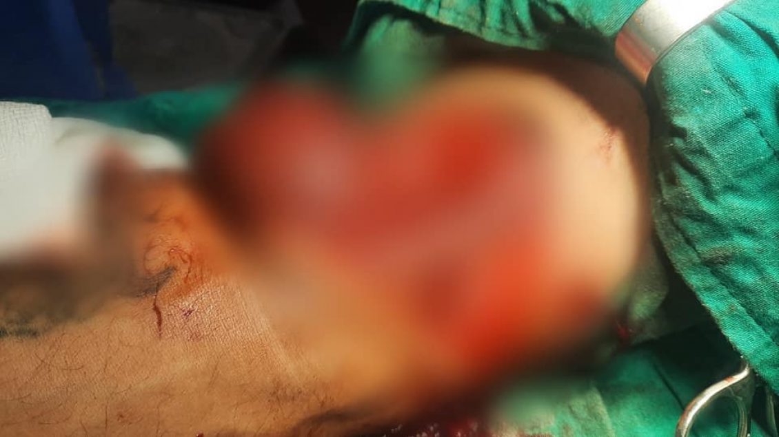 Operacion i rrallë në QKUK, i shpëtohet krahu pacientit që pothuajse e kishte të amputuar