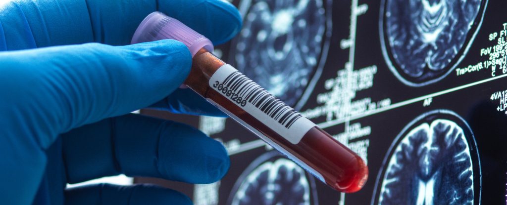 Deri ku ka arritur kërkimi për kurën e Alzheimerit?