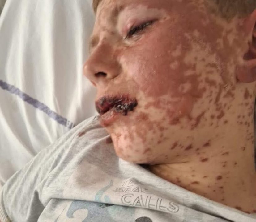 Apel urgjent për ndihmë: Sadiku po lufton për jetën pas sindromës Stevens–Johnson