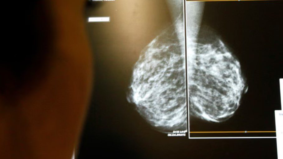 Përdorimi i AI-së në mamografi ul rastet e kancerit të gjirit të diagnostikuar me vonesë