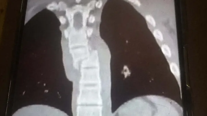 I riu nga Lipjani aksidentohet rëndë me motor, kërkohet ndihmë urgjente për t’i mbuluar shpenzimet mjekësore